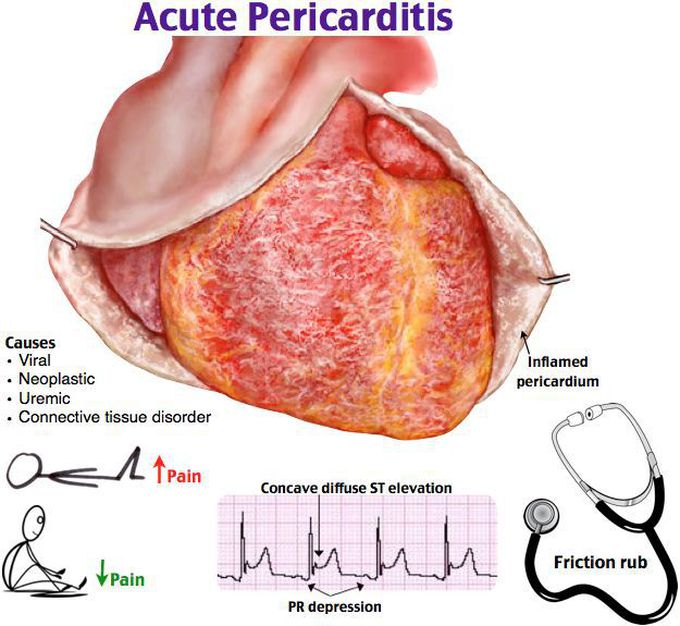 Cardio- Acut pericarditis