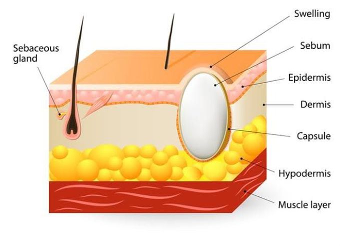 Cyst