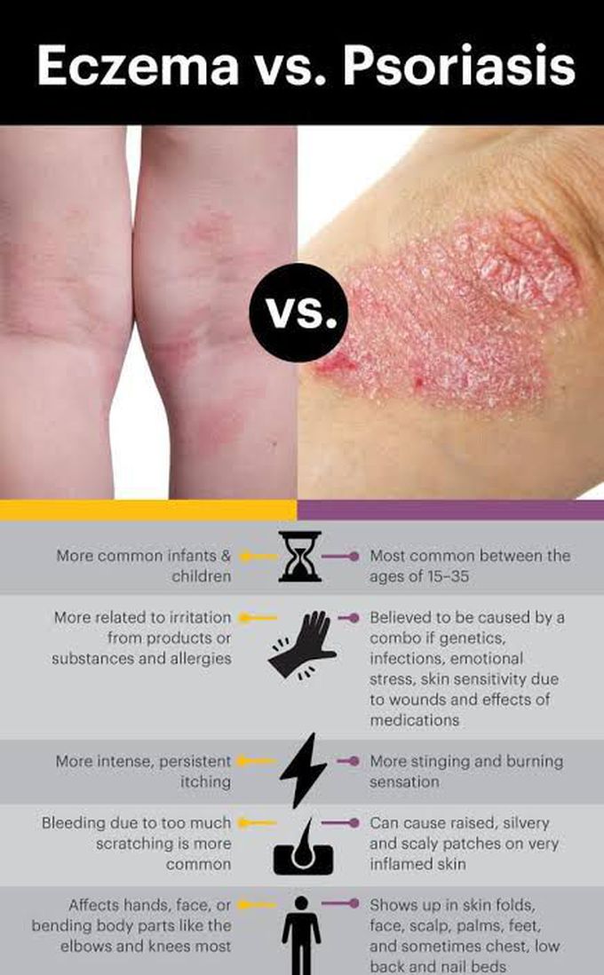 Eczema and psoriasis