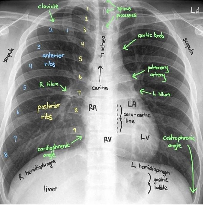 Chest radiograph (CXR)