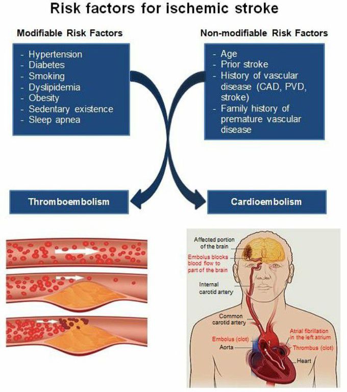 Ischemic stroke. Pathogenesis of ischemic stroke. Arterial Hypertension. Risk Factors for arterial Hypertension.