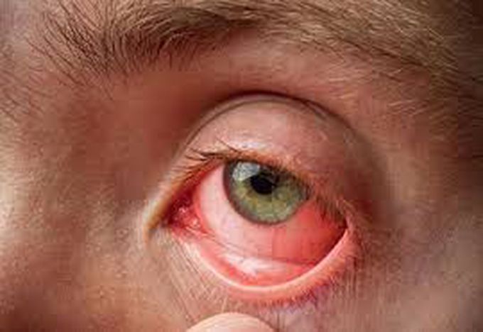 Conjunctivitis