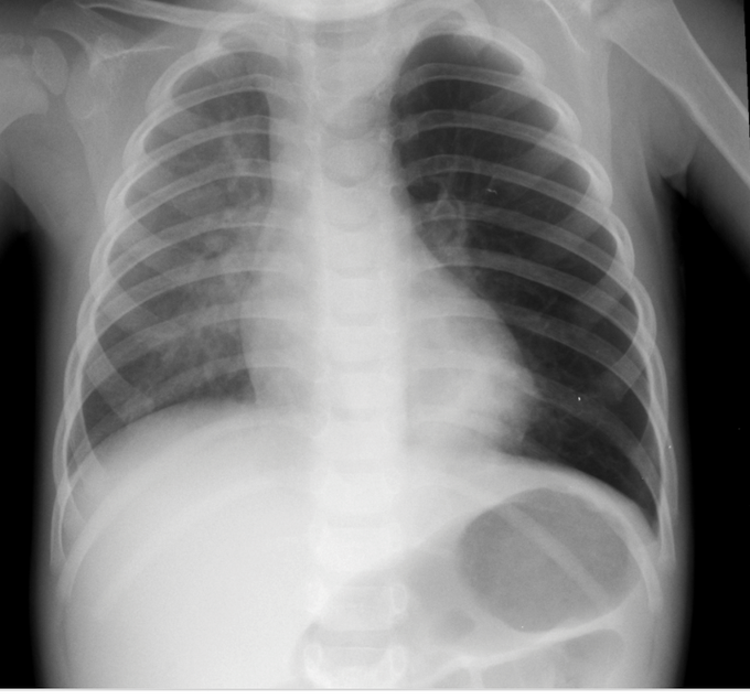 Pediatric Chest X-ray