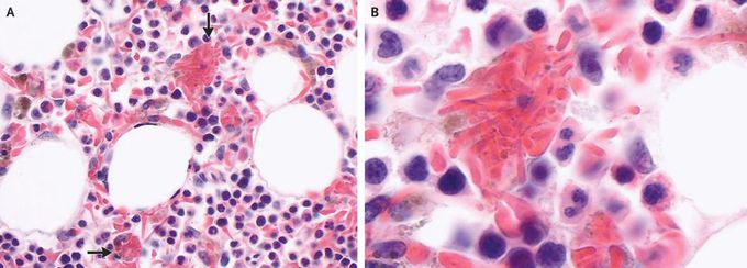 Hemophagocytosis of Sickle Cells