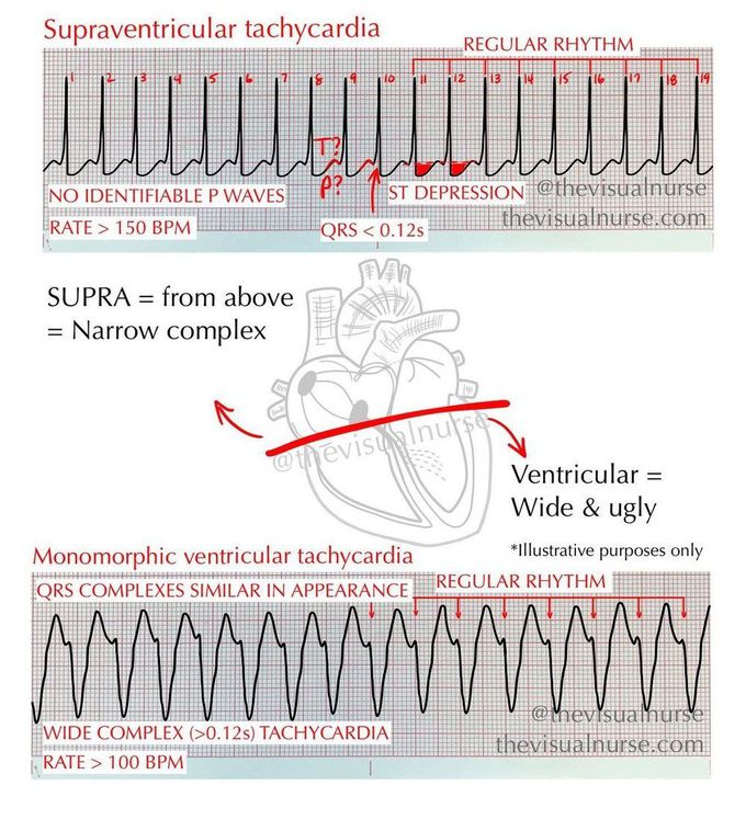 VT Vs SVT