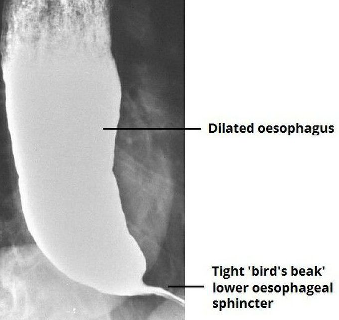 Achalasia