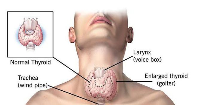 Hashimotos thyroiditis