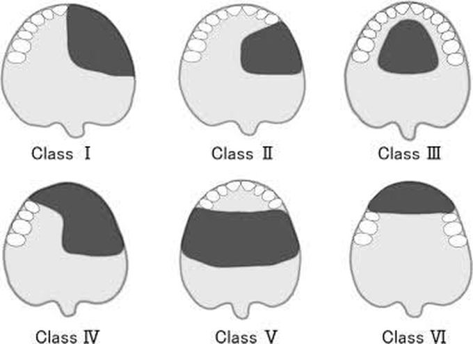 Armany's Classification of Intraoral Prosthesis