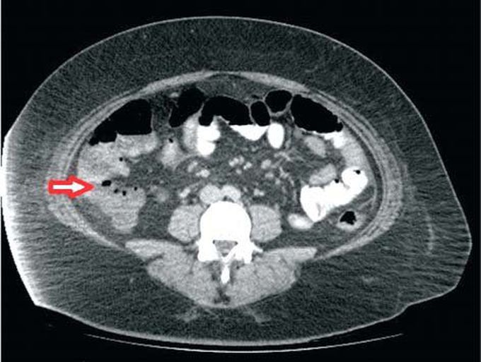 Acute Appendicitis on CAT Scan
