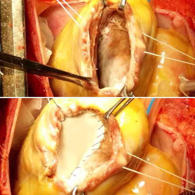 Left ventricle aneurism
