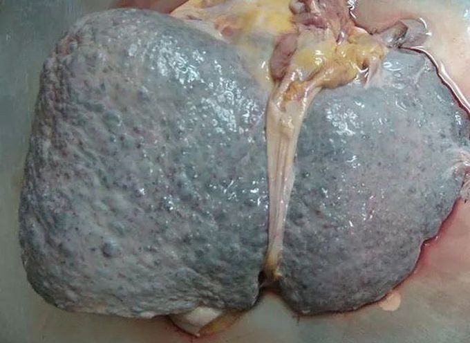 Cirrhosis of the liver