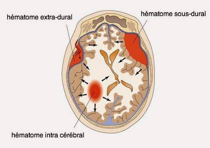 Hémorragie cérébral