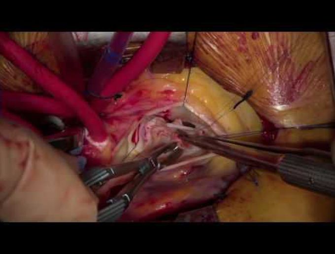 Minimally Invasive Repair of Severe Bicuspid Aortic Valve Endocarditis
