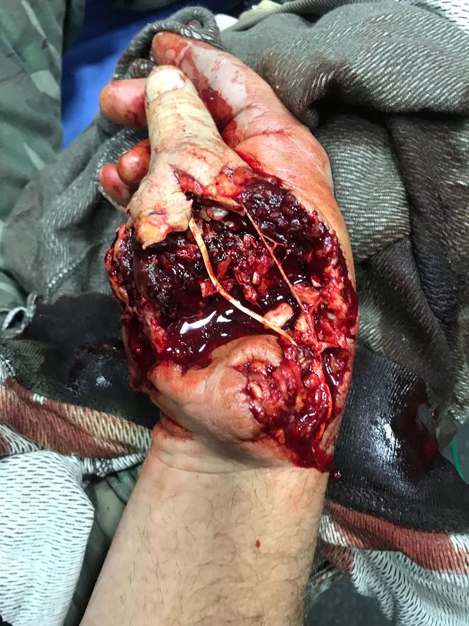 Hunting Accident