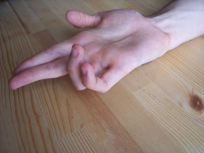 Claw hand