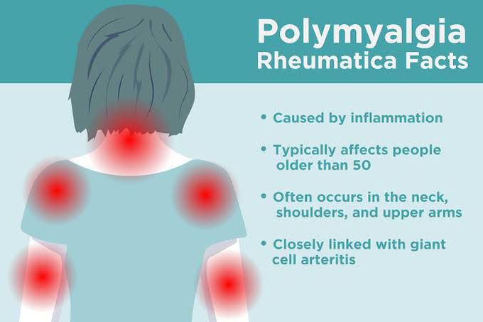 Polymyalgia Rheumatica