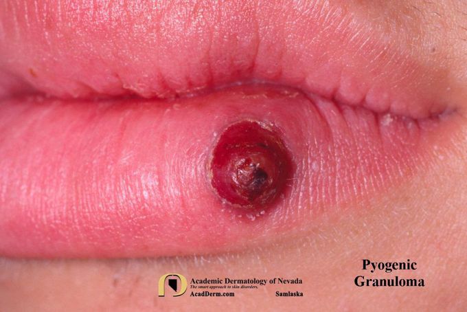 Pyogenic Granuloma