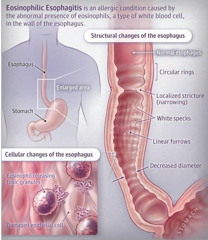 Eosinophilic esophagitis.