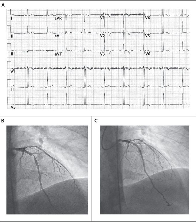 Wellens' Syndrome