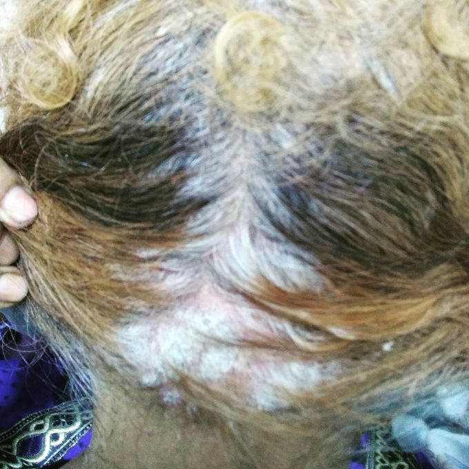 Psoriasis on scalp