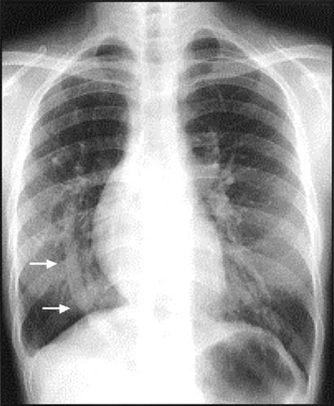 Scimitar syndrome - MEDizzy