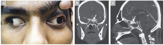 Carotid–Cavernous Sinus Fistula