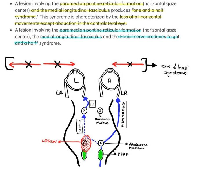 Internuclear Ophthalmoplegia II - MEDizzy