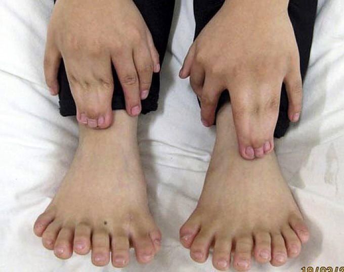 Solydactyly and synpolydactyly