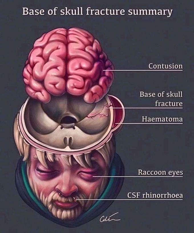 Base of skull fracture