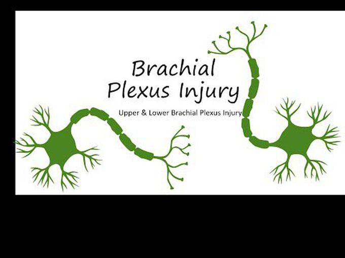 Clinical Aspects of the Brachial Plexus- Erb's and Klumpke's Palsy