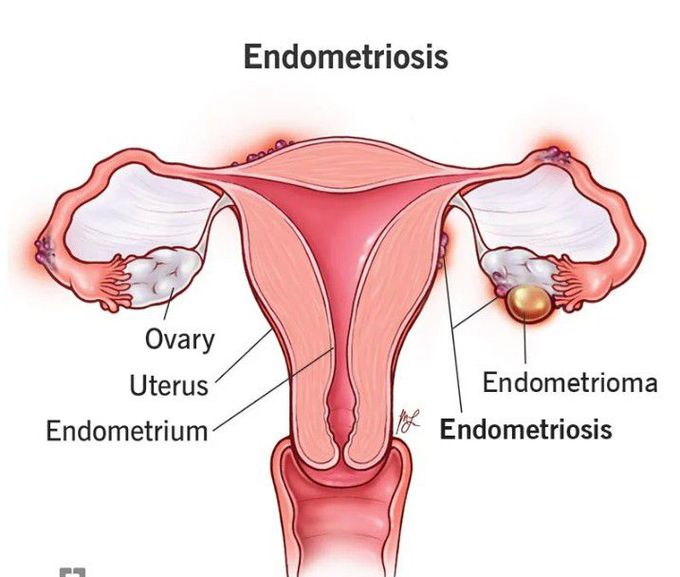 Endometriosis