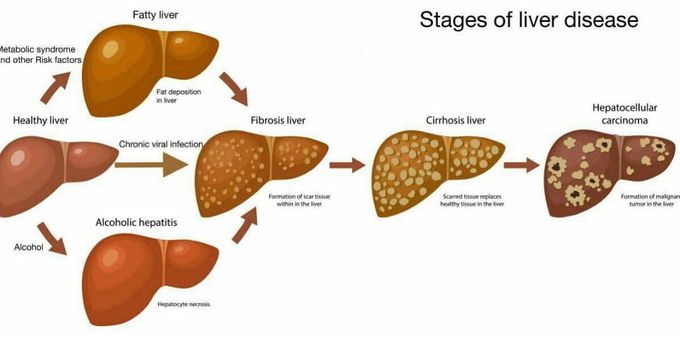 Stages of Liver Disease