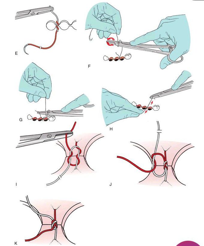 Surgeon's knot