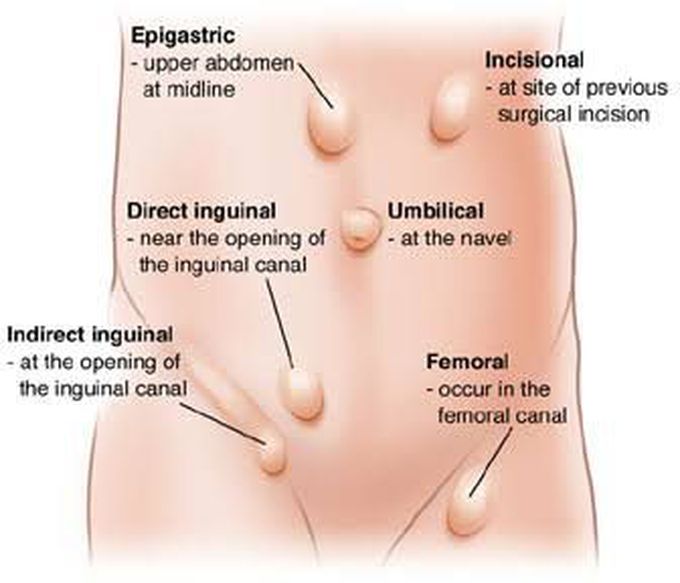 Types of Hernia