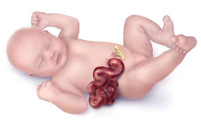How is gastroschisis treated?