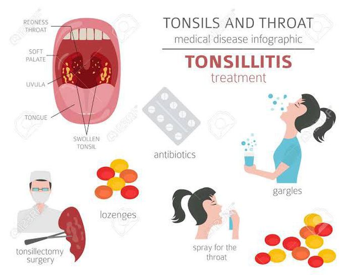 Treatment of tonsillitis.