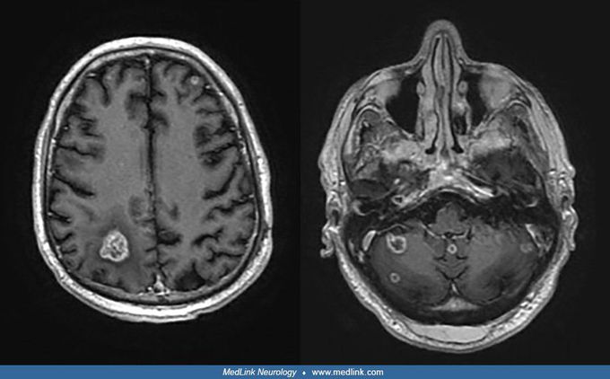 Brain Metastases