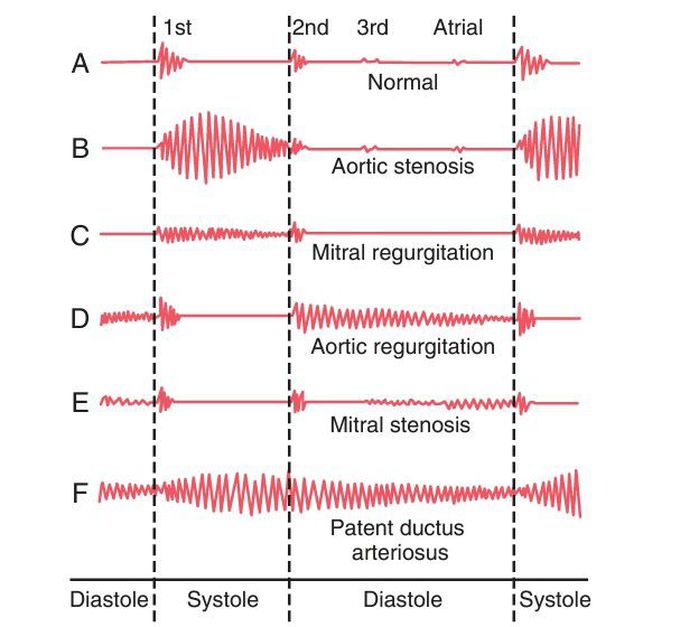 Phonocardiograms