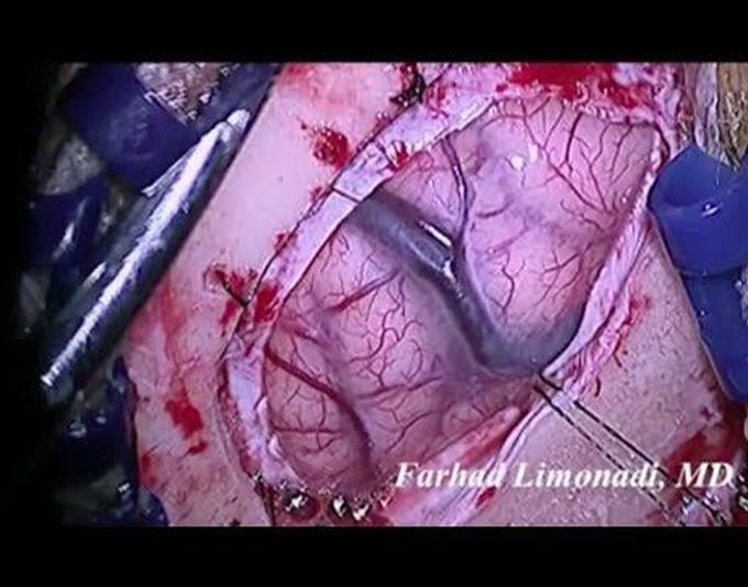Removal of a metastatic brain tumor (view through the surgical microscope)