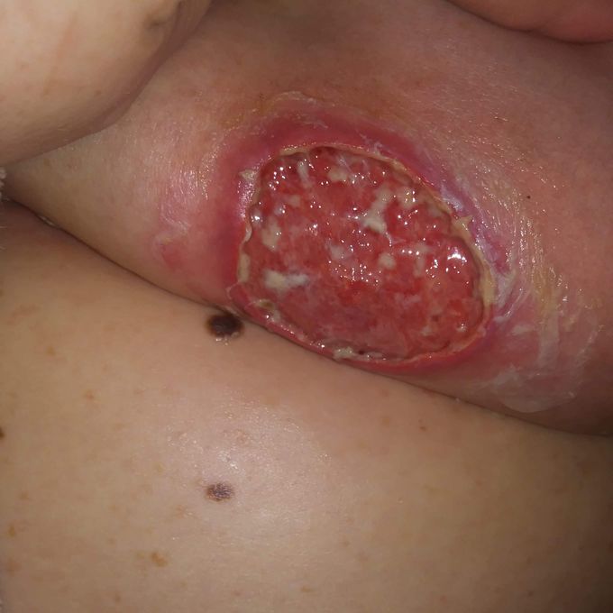 Pressure injury