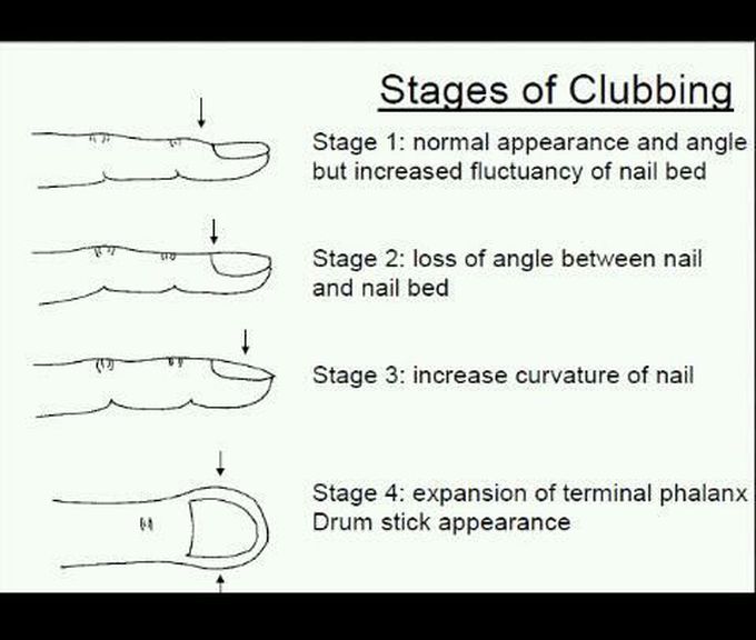 Stages of Clubbing