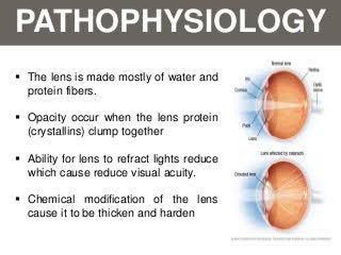 Cataracts - Pathophysiology