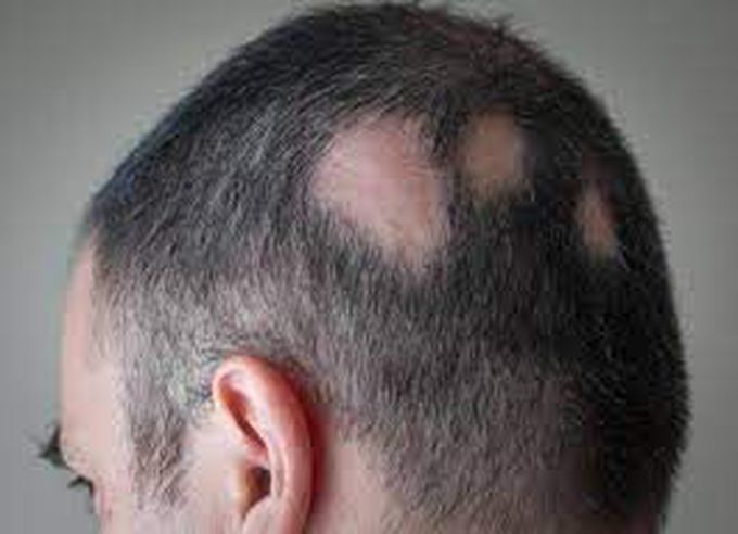 What causes alopecia areata?