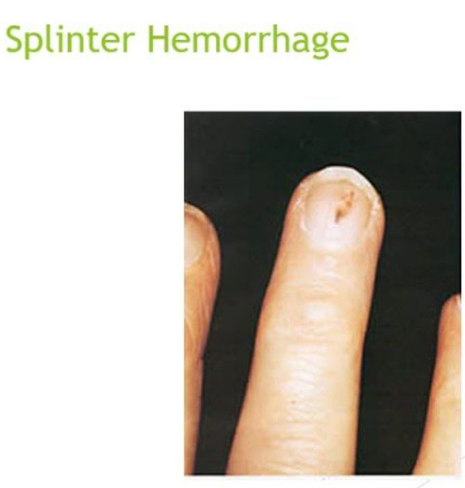 Splinter Hemorrhage