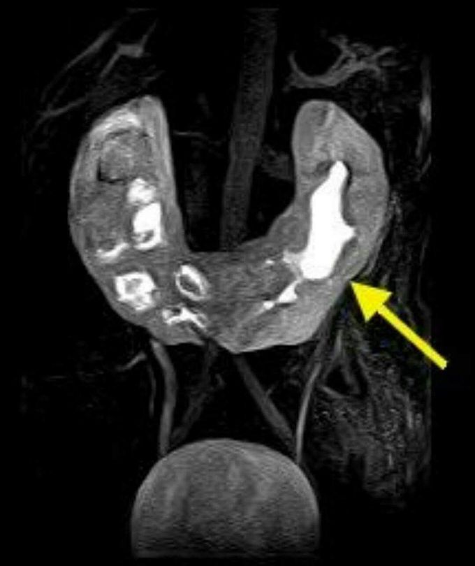 Horseshoe kidney