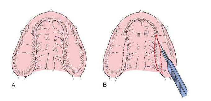 Removal of lateral palatal soft tissue.