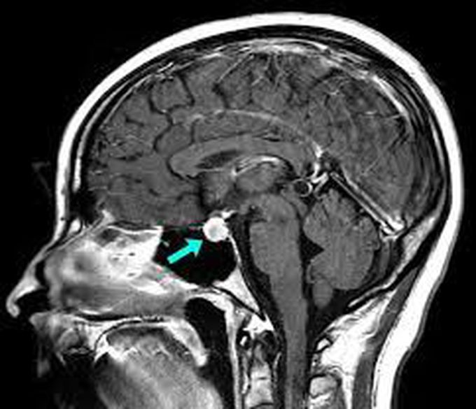 pituitary tumor