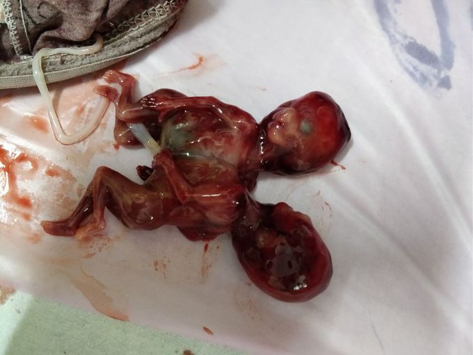 CONJOINED TWINS