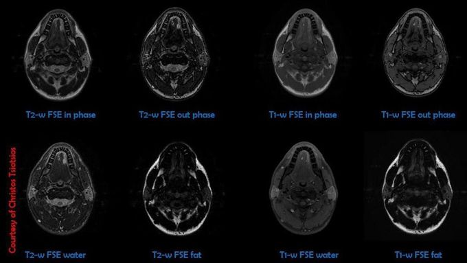 Neck MR imaging