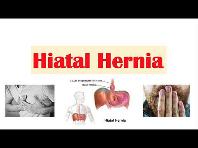 Hiatus Hernia: Overview